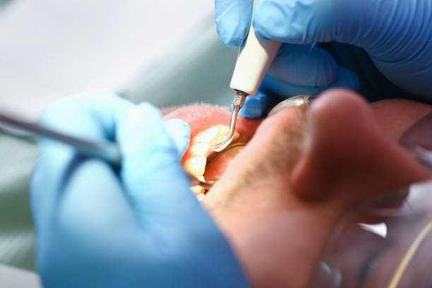 Best Dentist for Tooth Abscess  in Port Ludlow, WA